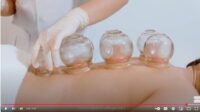 Cupping-Therapy-course